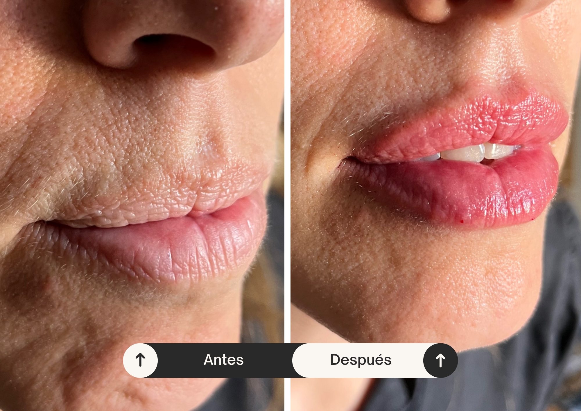 Medicina Estética | Tratamiento de rellenos de ácido hialurónico