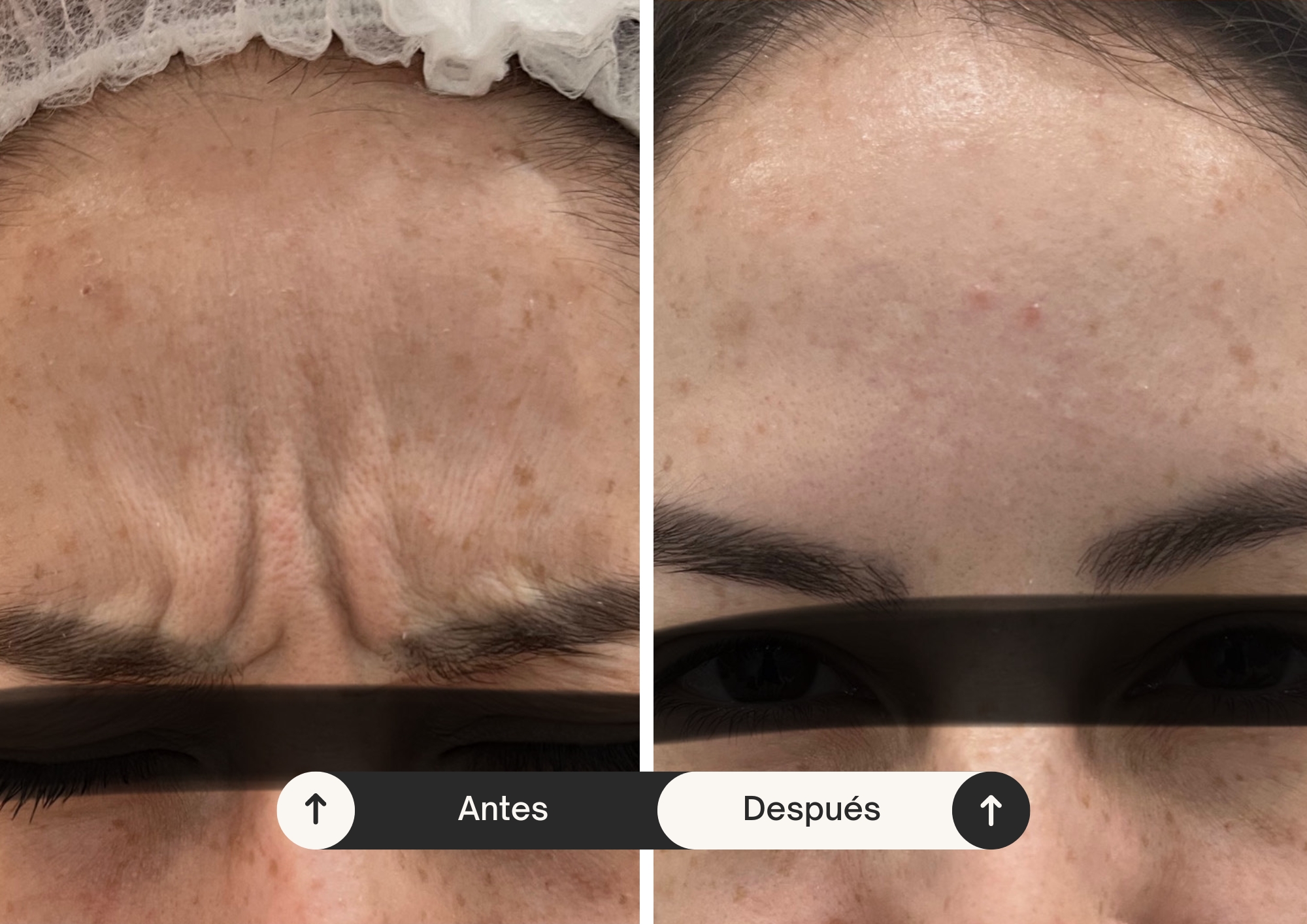 Tratamiento Facial | Rellenos de ácido hialurónico
