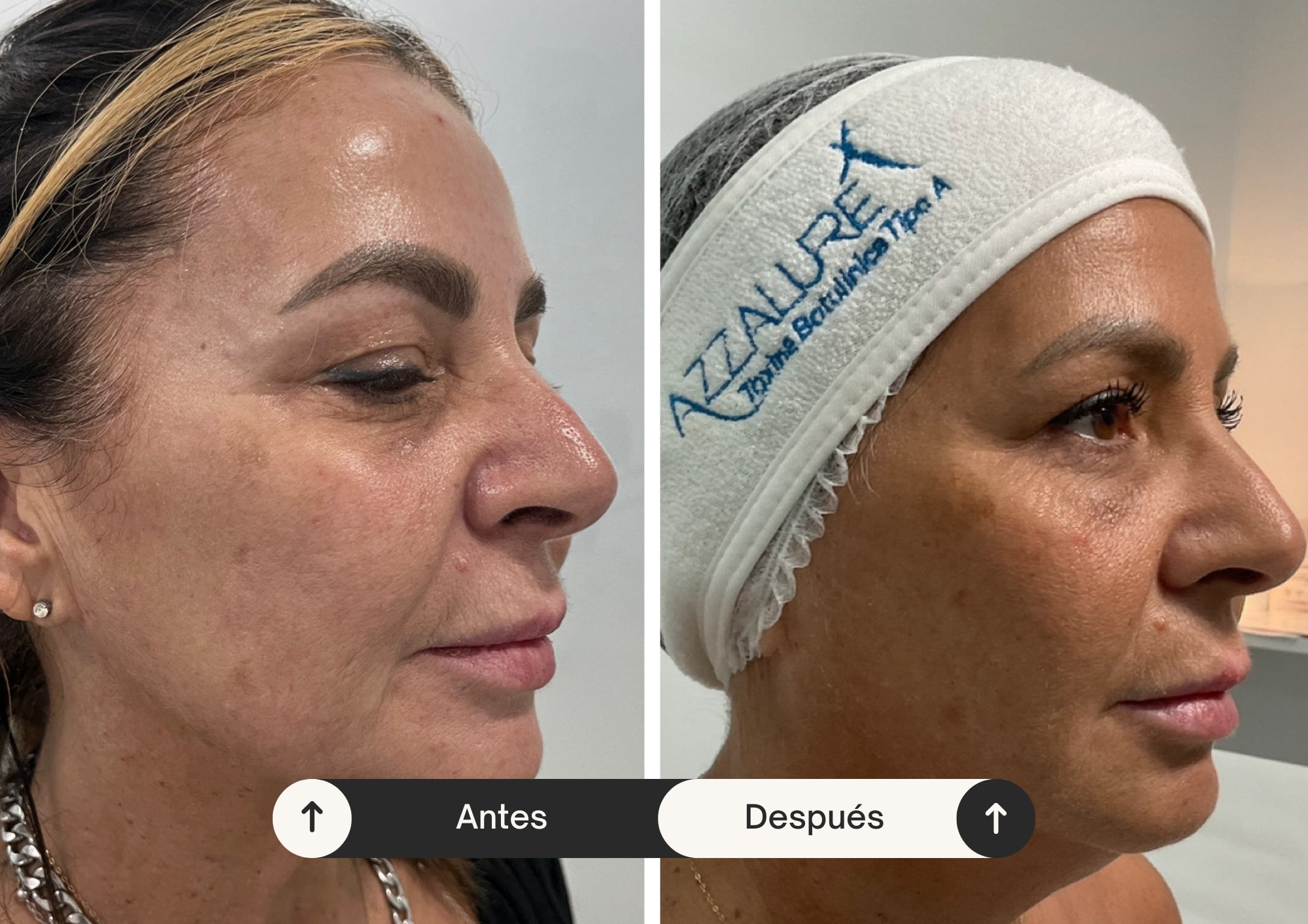 Foto de paciente después de un tratamiento: "Centro de estética facial y corporal en Madrid - Resultados reales